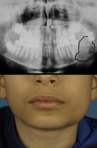 Folicular Cyst Folicular Cyst
