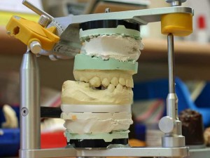 Dental Prosthesis Dental Prosthesis