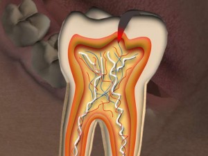 Fissure Caries Fissure Caries